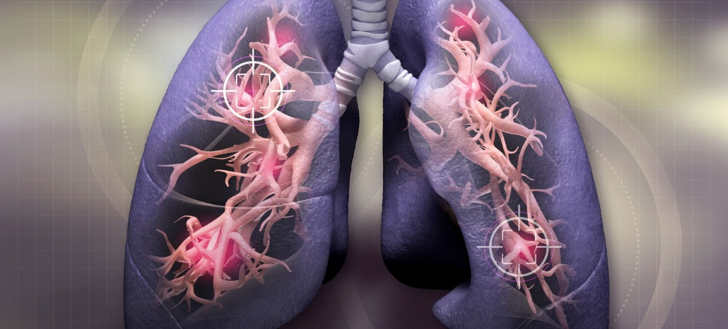 Hydrogen therapy can be used to control tumor progression